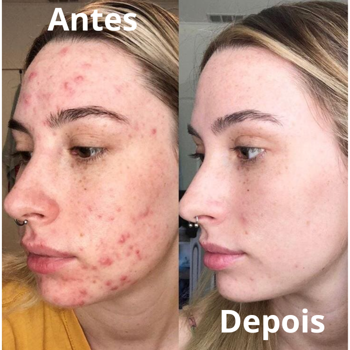 acnes no rosto