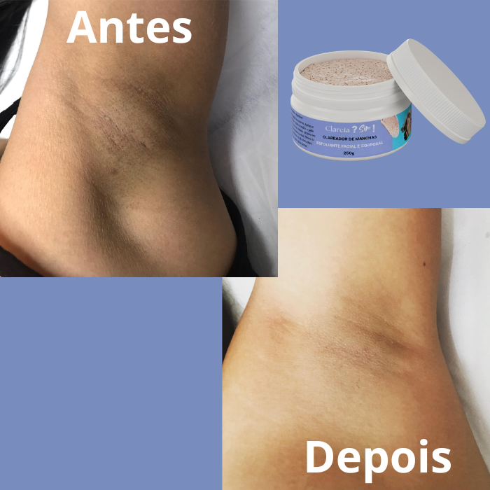 como clarear axila