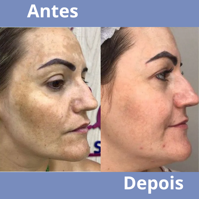 melasma no rosto